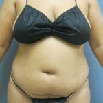 Liposuction Female Before & After Patient #11976