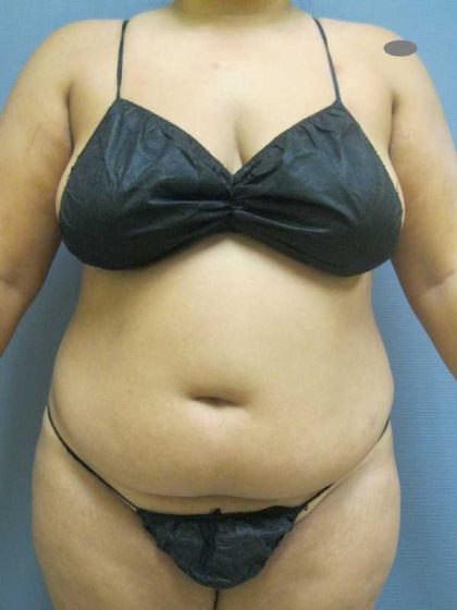 Liposuction Female Before & After Patient #11976
