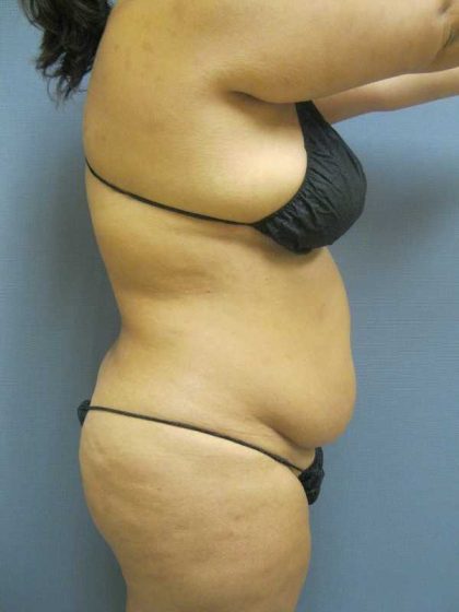 Liposuction Female Before & After Patient #11976