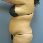 Liposuction Female Before & After Patient #11976