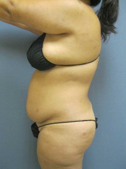 Liposuction Female Before & After Patient #11976