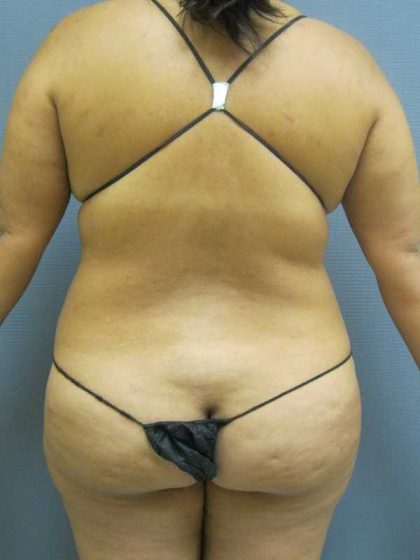 Liposuction Female Before & After Patient #11976