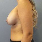 Asymmetric (Uneven) Breasts Before & After Patient #6400