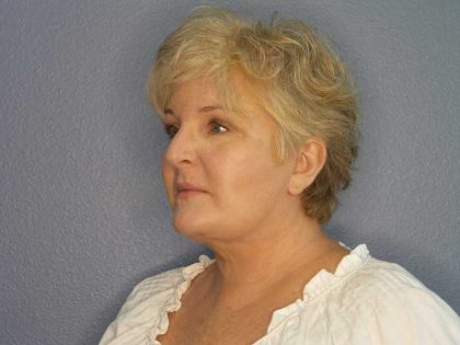 Facelift Before & After Patient #7546