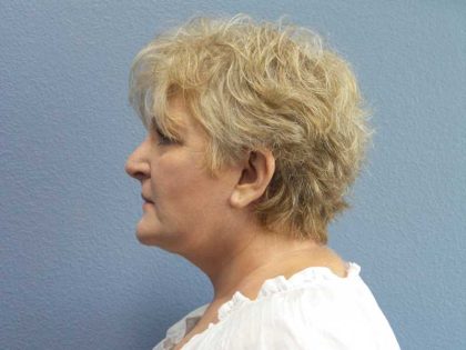 Facelift Before & After Patient #7546