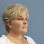 Facelift Before & After Patient #7546