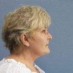 Facelift Before & After Patient #7546