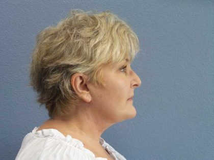 Facelift Before & After Patient #7546