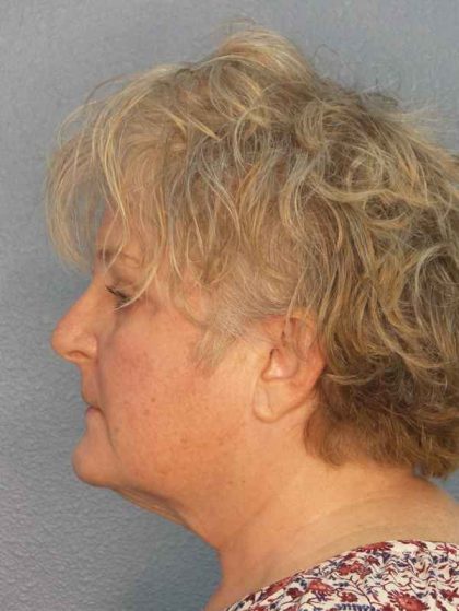 Facelift Before & After Patient #7546