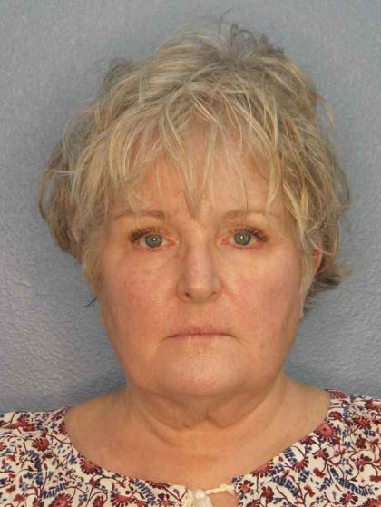 Facelift Before & After Patient #7546