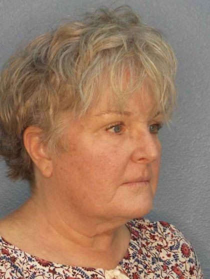 Facelift Before & After Patient #7546