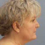Facelift Before & After Patient #7546