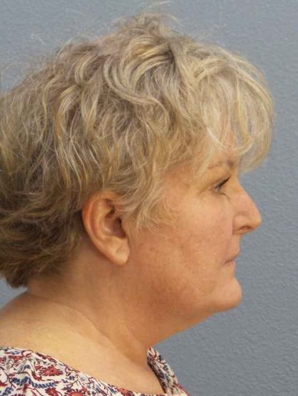 Facelift Before & After Patient #7546