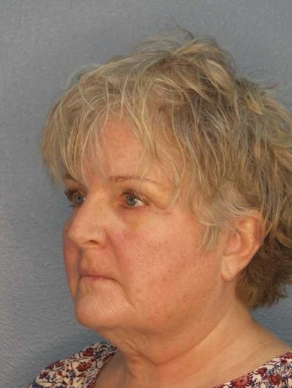 Facelift Before & After Patient #7546