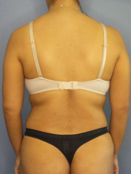 Liposuction Female Before & After Patient #7768