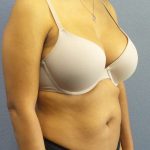 Liposuction Female Before & After Patient #7768