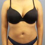 Liposuction Female Before & After Patient #7768