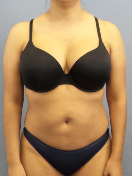 Liposuction Female Before & After Patient #7768