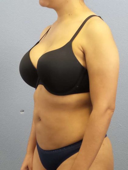 Liposuction Female Before & After Patient #7768