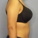 Liposuction Female Before & After Patient #7768