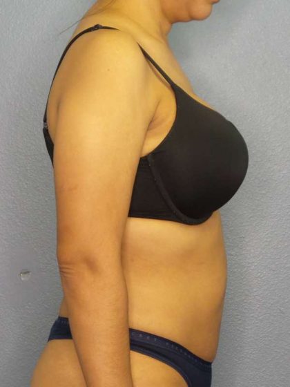 Liposuction Female Before & After Patient #7768