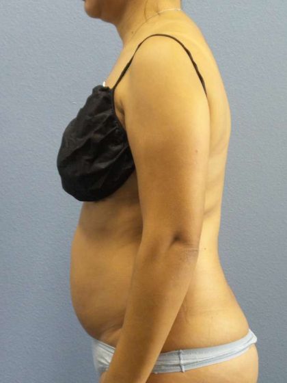 Liposuction Female Before & After Patient #7768