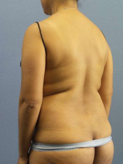 Liposuction Female Before & After Patient #7768