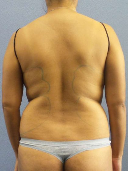 Liposuction Female Before & After Patient #7768