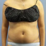 Liposuction Female Before & After Patient #7768