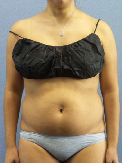 Liposuction Female Before & After Patient #7768