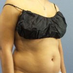 Liposuction Female Before & After Patient #7768