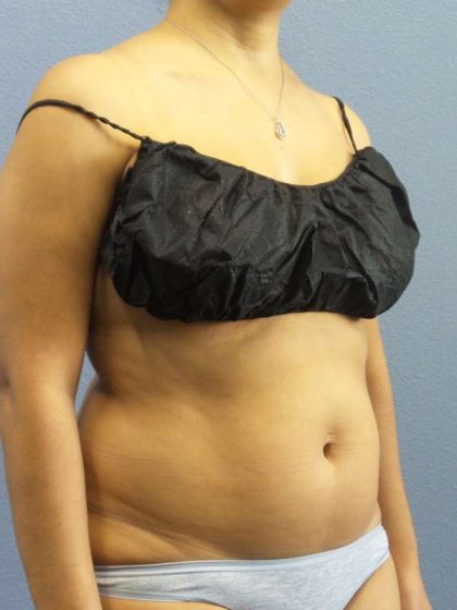 Liposuction Female Before & After Patient #7768