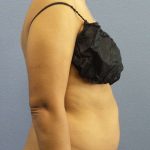 Liposuction Female Before & After Patient #7768
