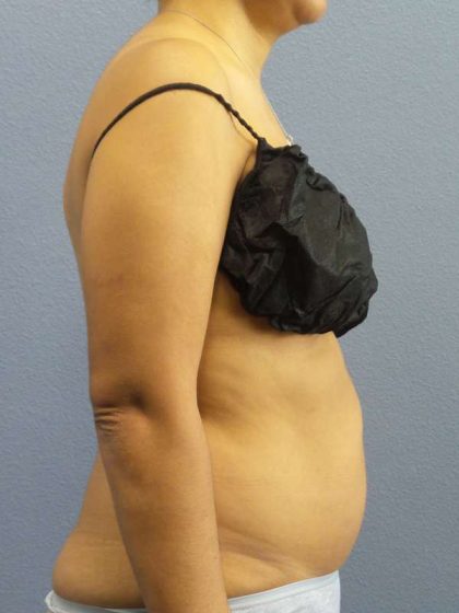Liposuction Female Before & After Patient #7768