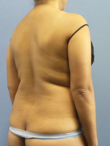 Liposuction Female Before & After Patient #7768