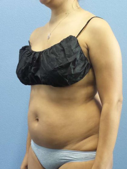 Liposuction Female Before & After Patient #7768