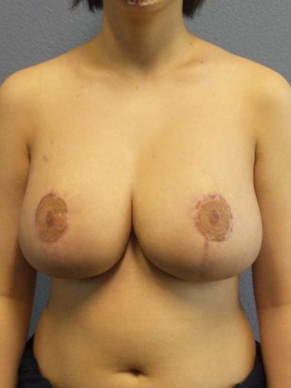 Breast Reduction Before & After Patient #7476