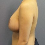 Breast Reduction Before & After Patient #7476
