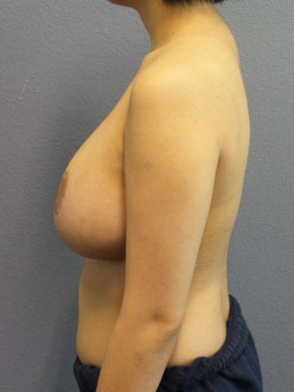 Breast Reduction Before & After Patient #7476