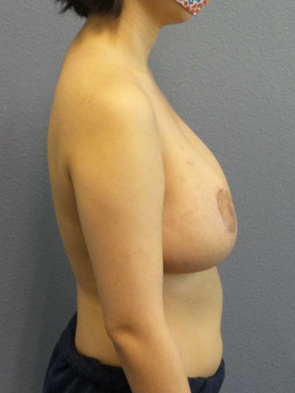 Breast Reduction Before & After Patient #7476