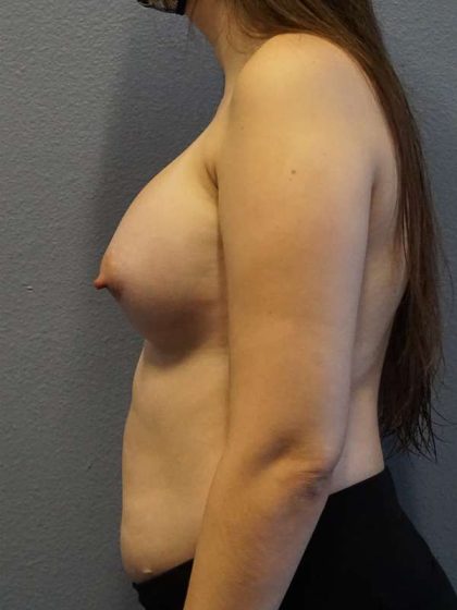 Breast Augmentation Before & After Patient #6026