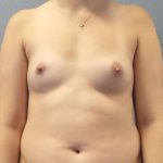 Breast Augmentation Before & After Patient #6026