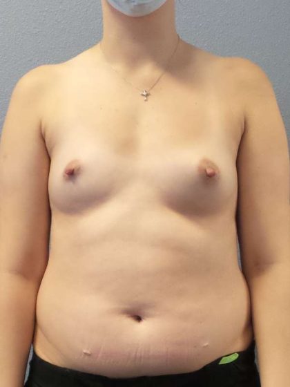 Breast Augmentation Before & After Patient #6026