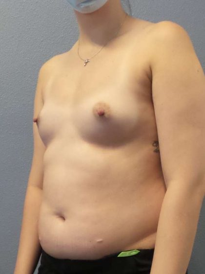 Breast Augmentation Before & After Patient #6026