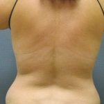 Liposuction Female Before & After Patient #7913