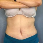 High BMI (Larger Patients) Surgery Before & After Patient #10466