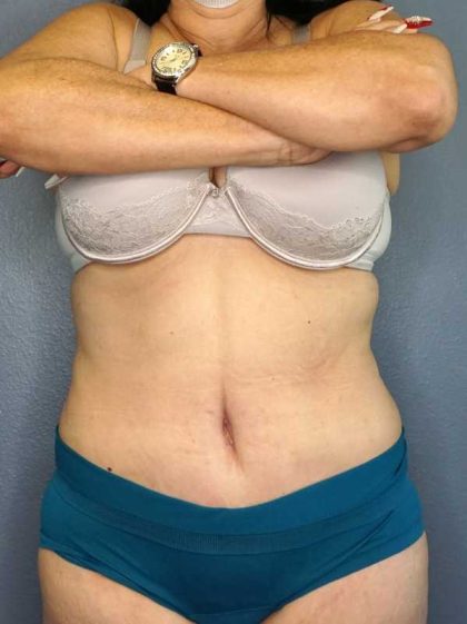 High BMI (Larger Patients) Surgery Before & After Patient #10466