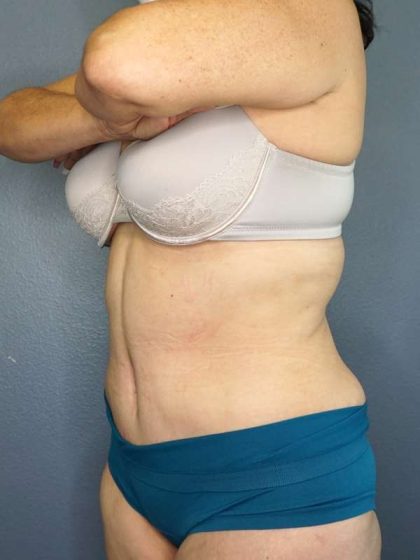 Abdominoplasty Before & After Patient #3854