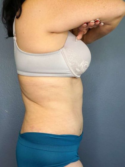 Abdominoplasty Before & After Patient #3854