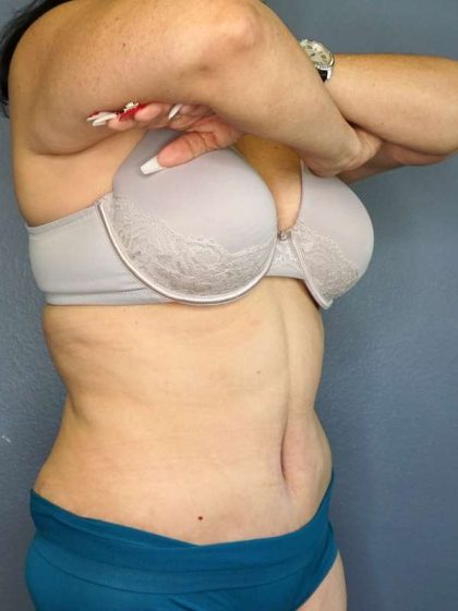 Abdominoplasty Before & After Patient #3854